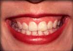 Show A lot of Gums Before Testimonial